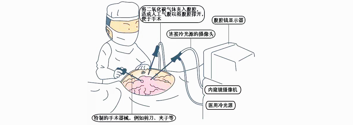 腹腔镜摄像机使用步骤及注意事项