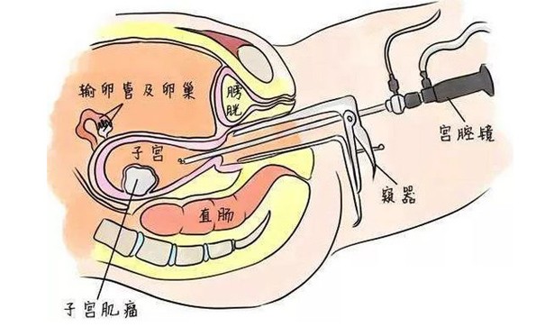 宫腔镜检查方法以及正常宫腔图像